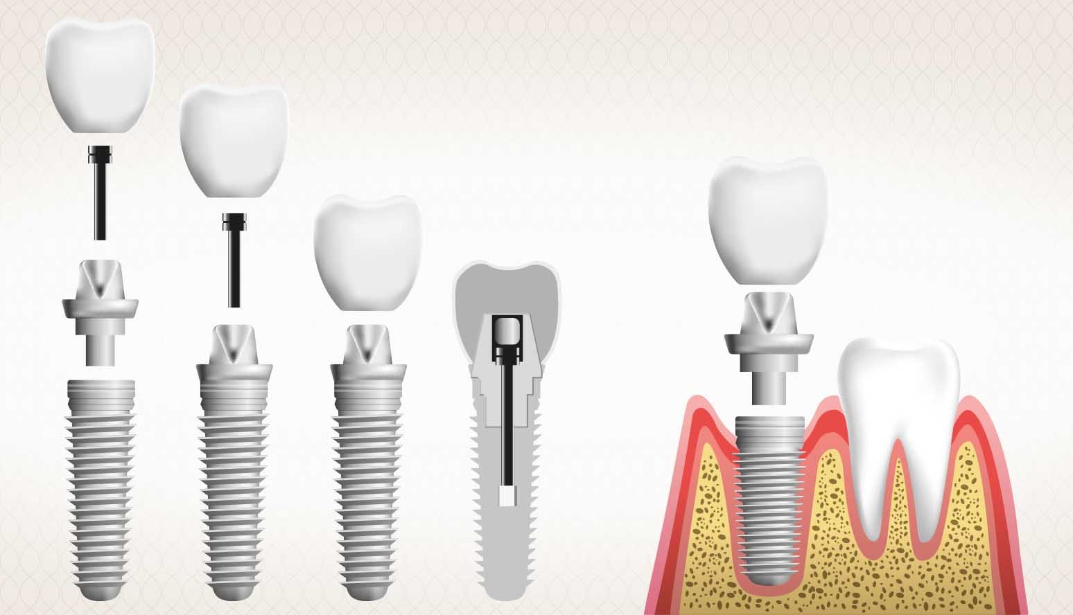 dental implants Auckland